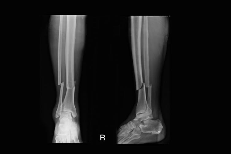 An x-ray showing a bone fracture on a person's leg.