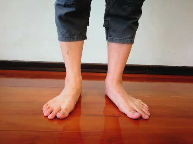 Person with flat feet