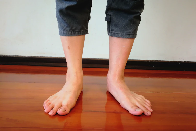 Person with flat feet
