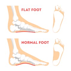 A flat foot compared to a normal foot