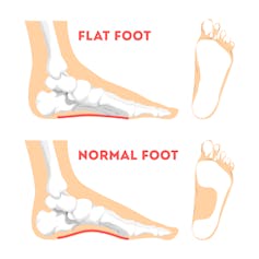 A flat foot compared to a normal foot