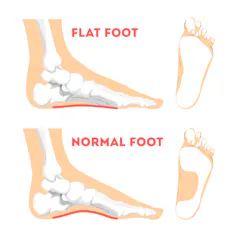 A flat foot compared to a normal foot