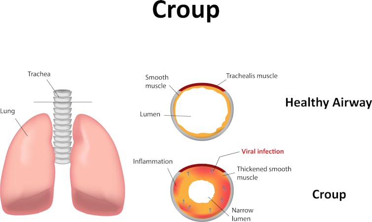 Graphic of croup airways.