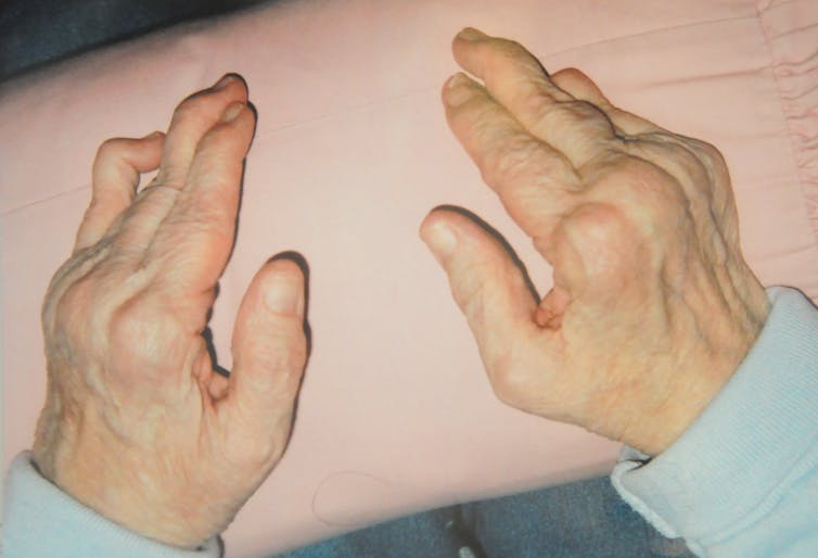 A pair of fair-skinned hands with extremely swollen knuckles, the end of the left pinky sharply angled at the top knuckle and light blue sleeve cuffs at the wrists.