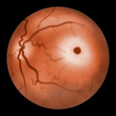Illustration of a cherry-red spot on the retina of someone with Tay-Sachs