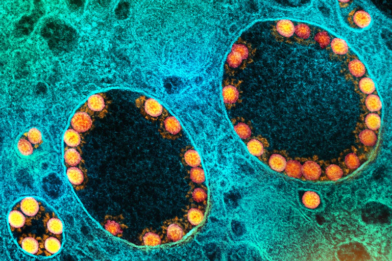 Transmission electron micrograph of yellow SARS-CoV-2 virus particles inside a blue-coloured cell.