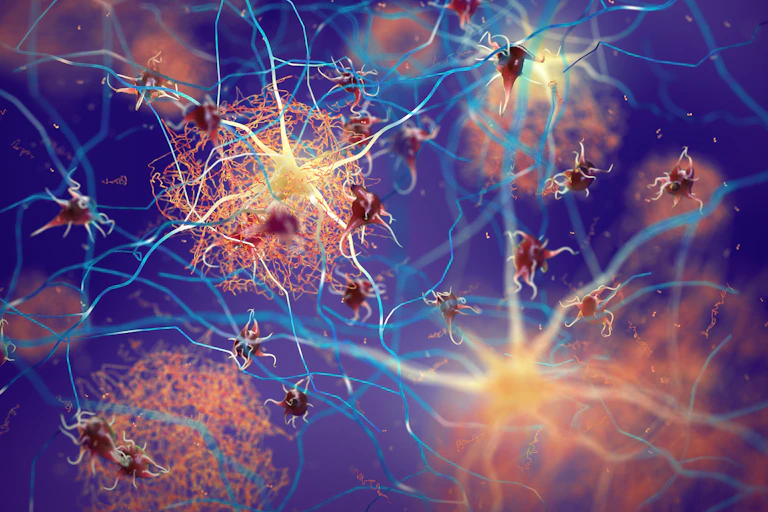 Beta-amyloid plaques forming on the brain's neurons.