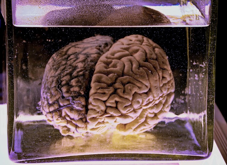 Human brain suspended in liquid in a jar.