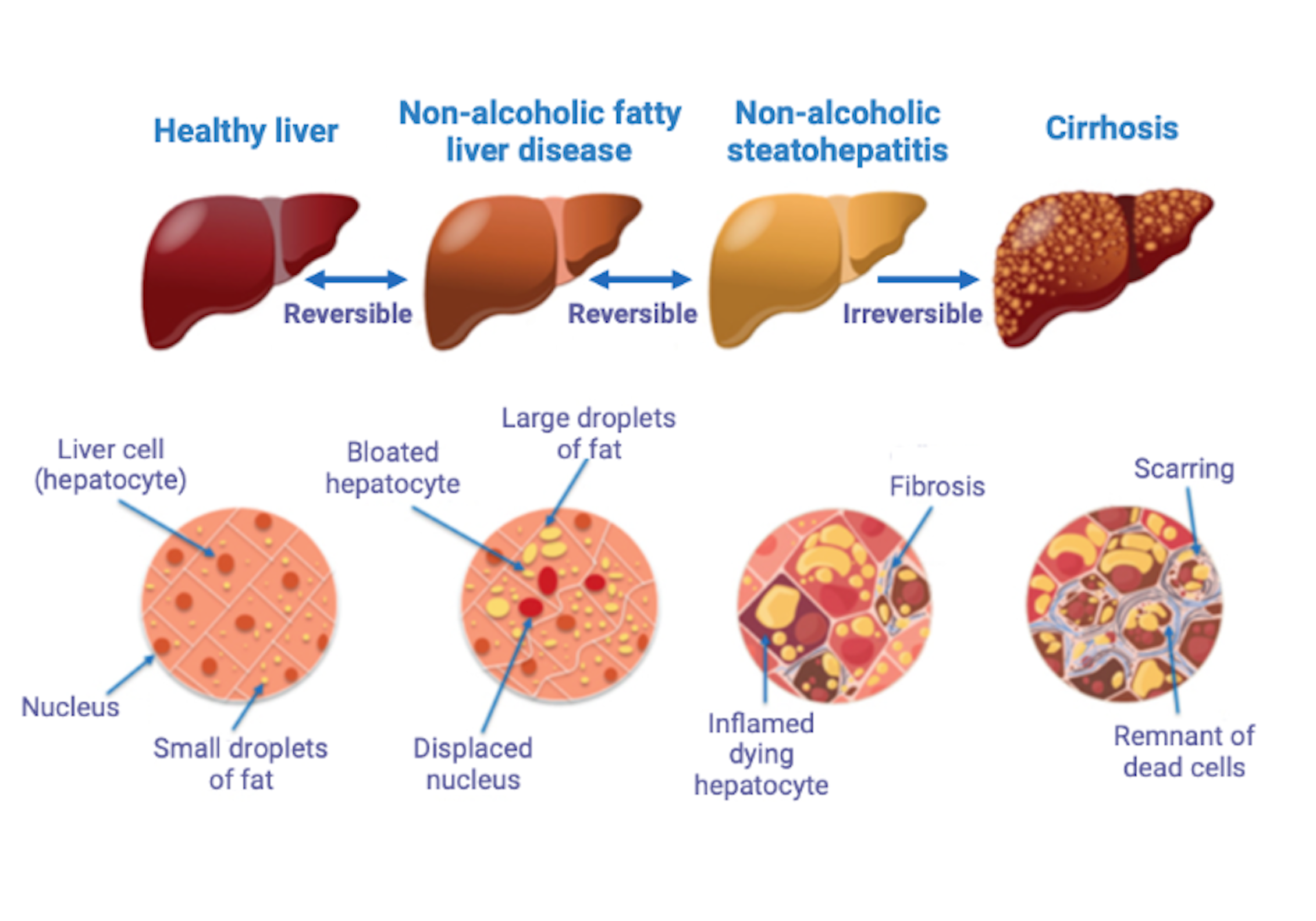 fatty liver disease essay grade 11