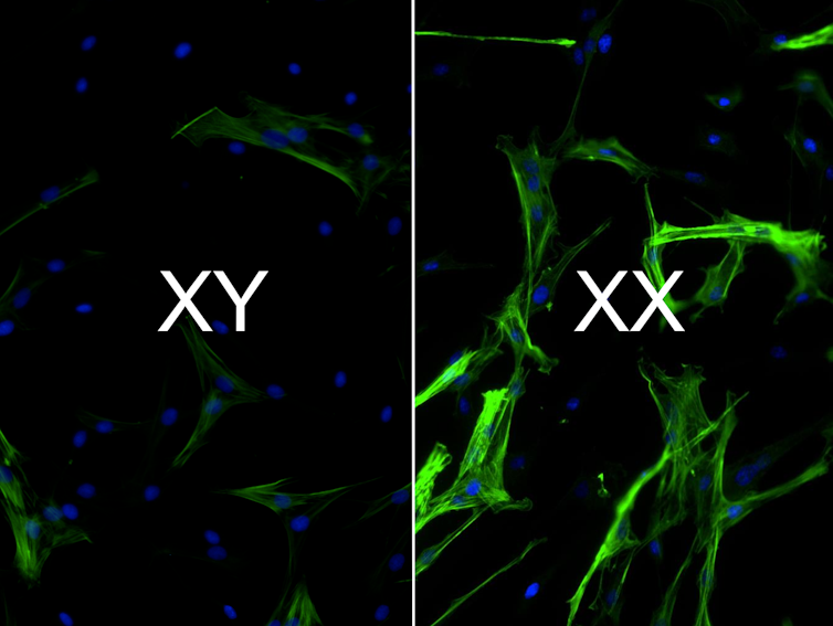 Microscopy images comparing the presence of scar-promoting cells XY and XX heart cells, colored green with blue nuclei.