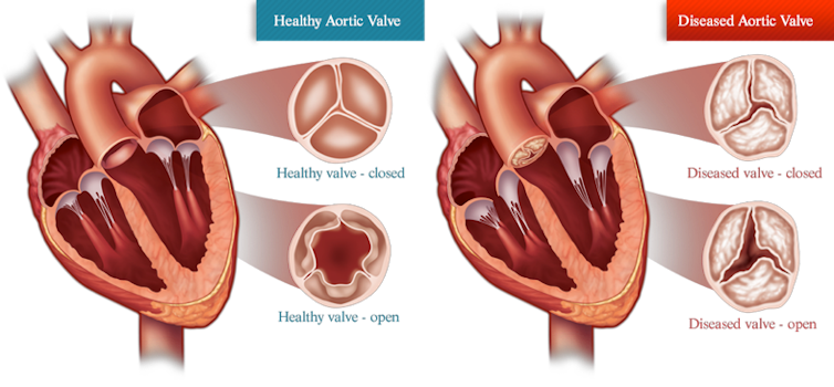 Diagram comparing a heart with a healthy aortic valve and a heart with aortic valve stenosis. The healthy valve opens fully while the diseased valve has a ragged and narrow opening.