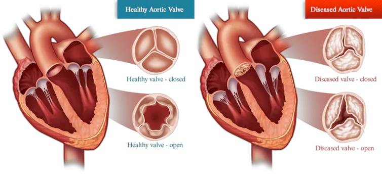 Diagram comparing a heart with a healthy aortic valve and a heart with aortic valve stenosis. The healthy valve opens fully while the diseased valve has a ragged and narrow opening.