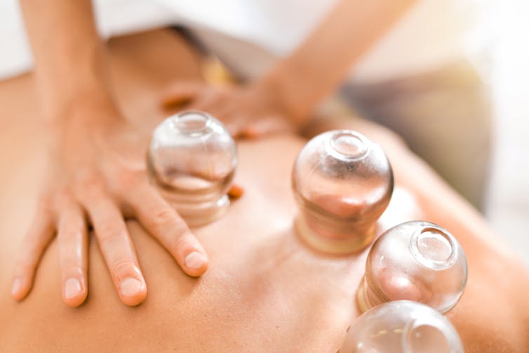 Cups on someone's back as part of cupping therapy