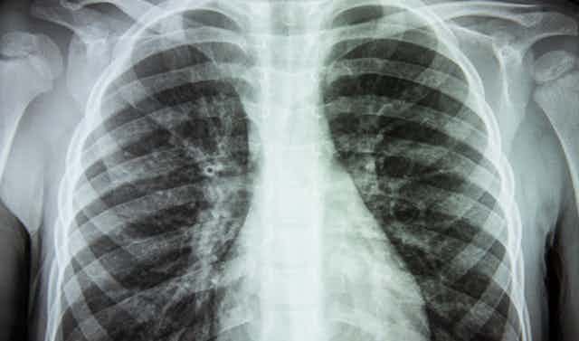 A chest X-ray showing lungs with scarring