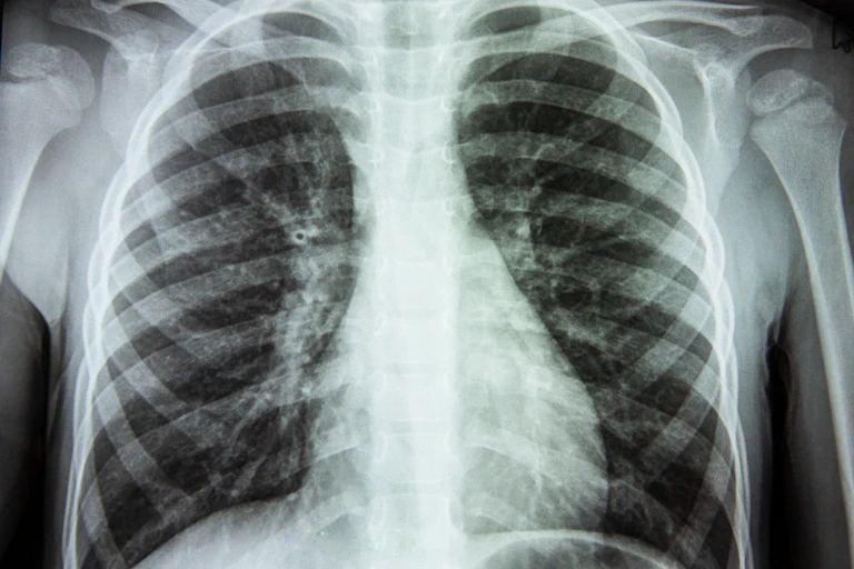 A chest X-ray showing lungs with scarring