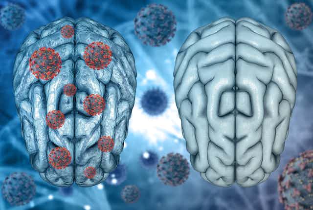 3D rendering showing two brains side by side; the one on the left has SARS-CoV-2 virus particles drawn on it while the other represents a healthy brain with no viral particles. 