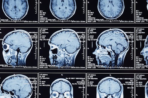 Even mild COVID can cause brain shrinkage and affect mental function, new study shows