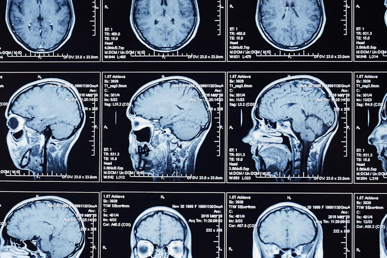 MRI brain scans