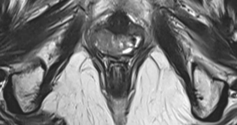 Black and white magnetic resonance images showing the female reproductive system with the vagina at center.