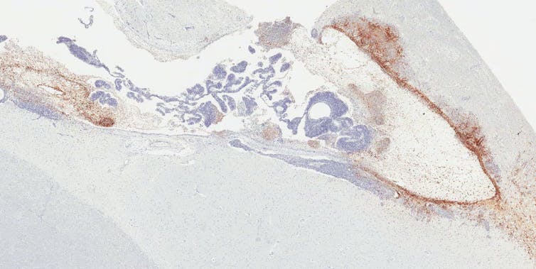 Ventricular system of rhesus monkey that survived Ebola virus infection, with brown stains indicating viral persistence lining the edges