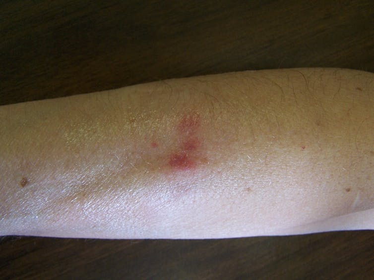 pink irritated patch on white skin of one arm