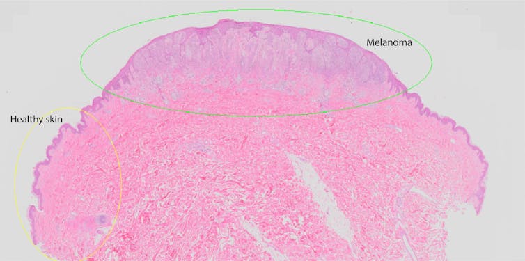 A hematoxylin and eosin stained section of a melanoma for microscopic inspection.