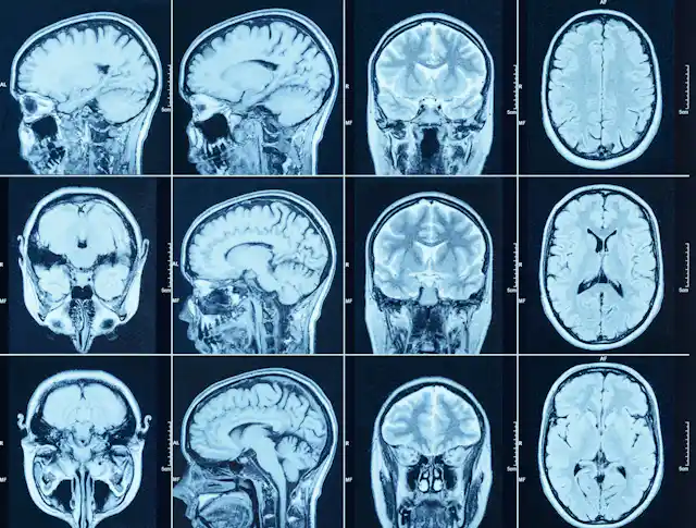 Brain charts: first comprehensive view of how the brain changes over a ...