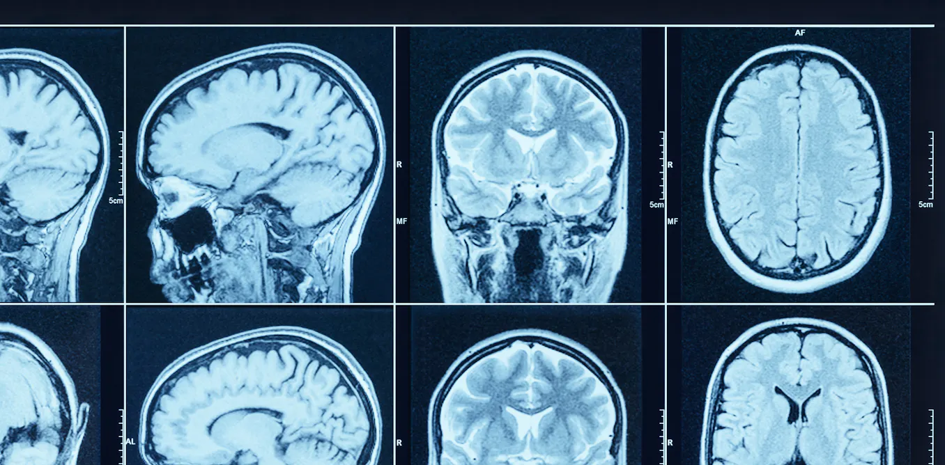 Brain charts: first comprehensive view of how the brain changes over a ...