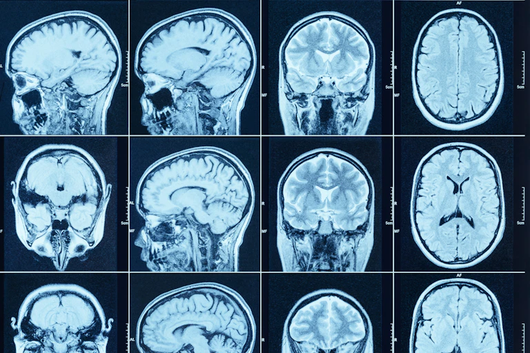 CT scans of a person's brain