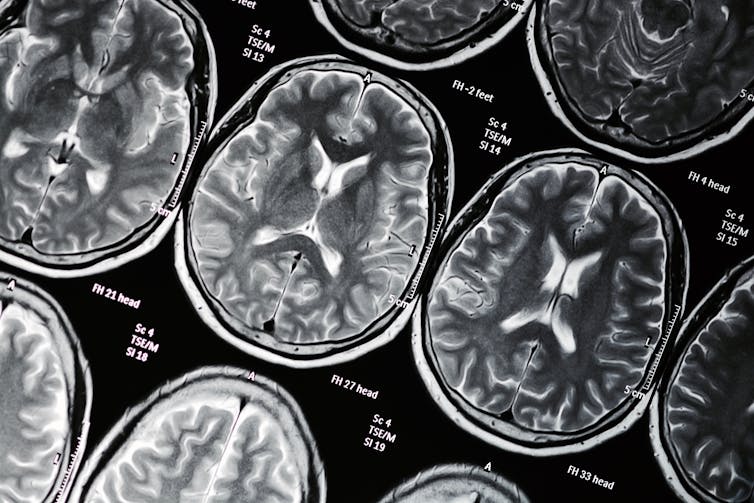 Image of fMRI brain scan pictures. Brain scans can help investigate how people respond to rewards. toysf400/Shutterstock