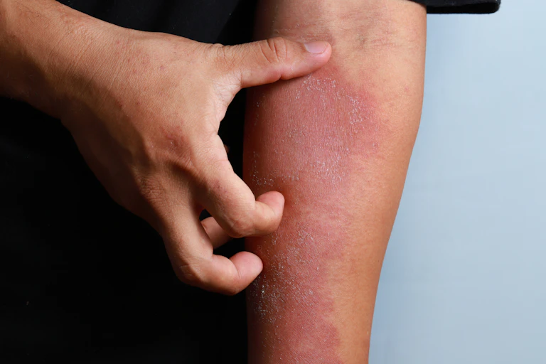 Person scratching rash on arm