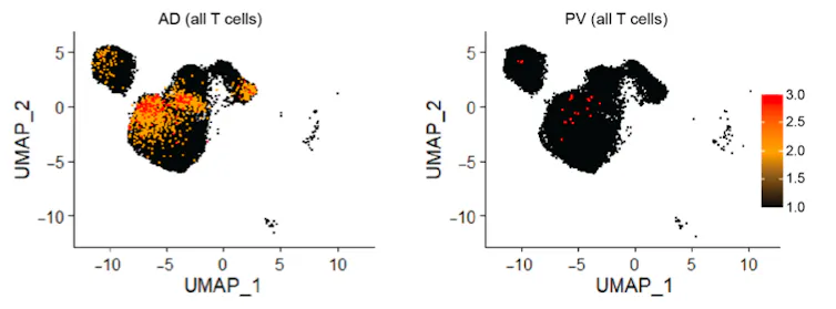 Single-cell RNA sequence graph comparing the immune cell profiles of atopic dermatitis versus eczema