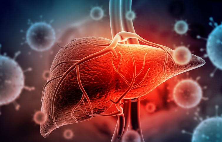 Illustration of hepatitis virus surrounding the liver