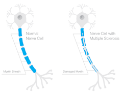 Diagram of two nerve cells, with one showing damage to the coating on the nerve stem