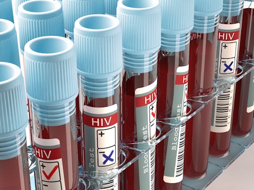 Por qué hay pacientes que vencen al virus del sida