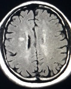 Brain scan showing whitish patches on gray brain area