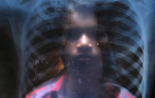 Man looking at chest X-ray
