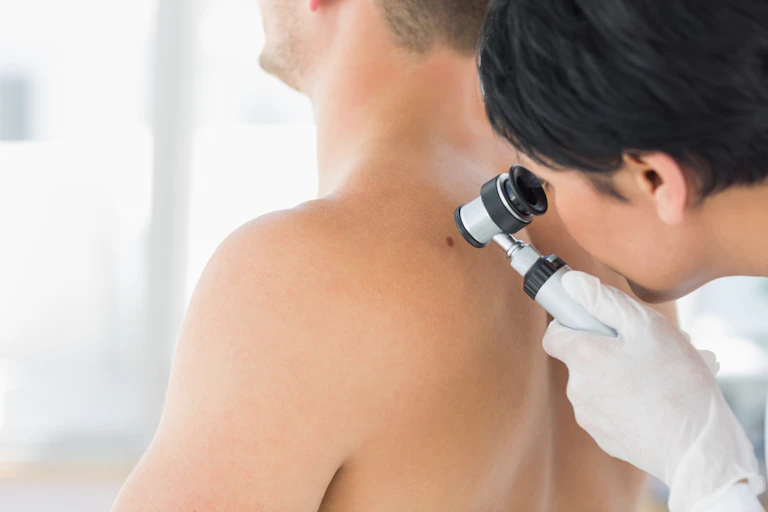 Doctor looking at mole