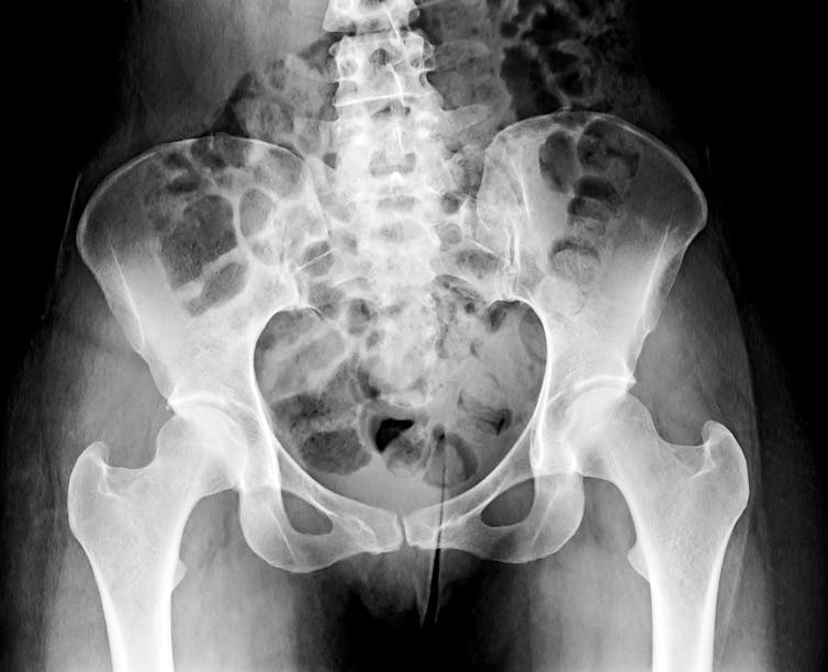 xray image of hips and pelvis