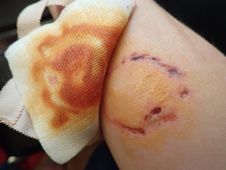 dog bite wound with bandage pulled back