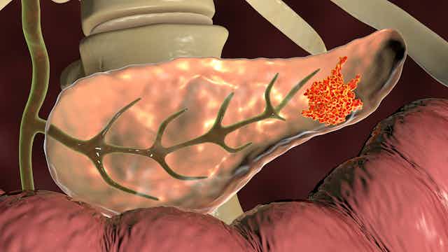 Cancer un mal que mata - Fin e...