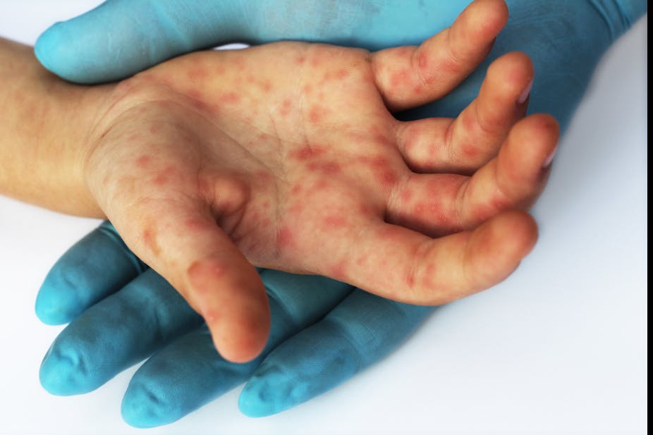 A child with measles rash on his hand, being held by a doctor's hand, who is wearing gloves.