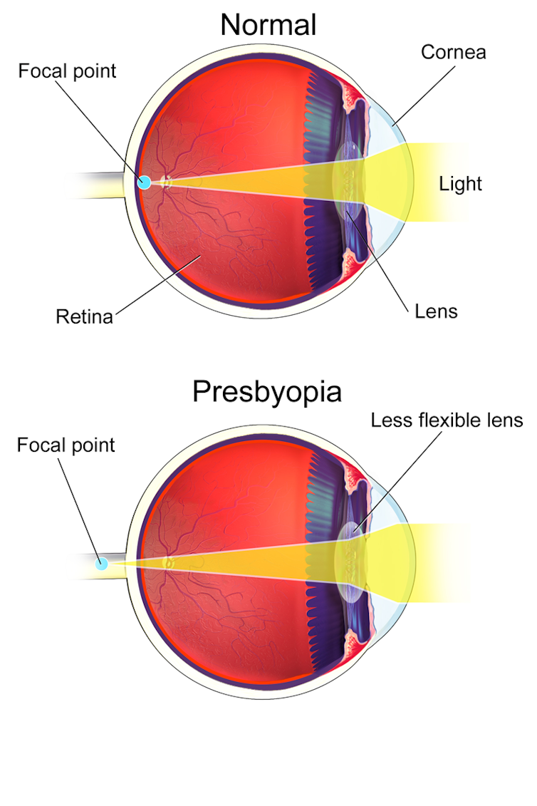 A diagram showing how the point of focus moves when a person has presbyopia.