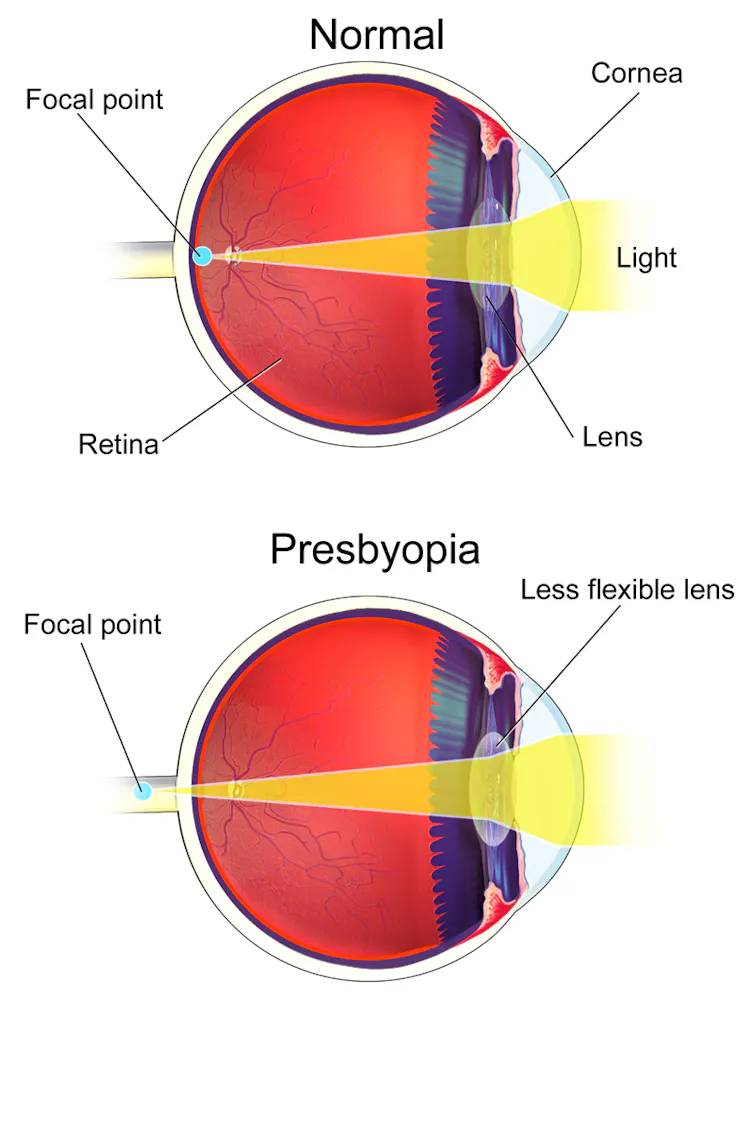 A diagram showing how the point of focus moves when a person has presbyopia.