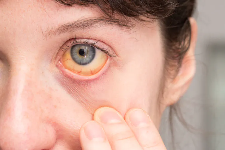 Un ojo con la esclerótica amarilla