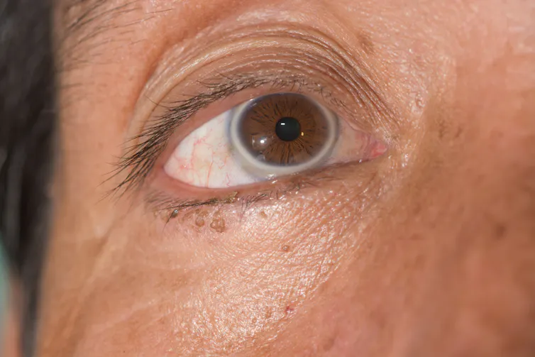 Un ojo con arcus senilis.
