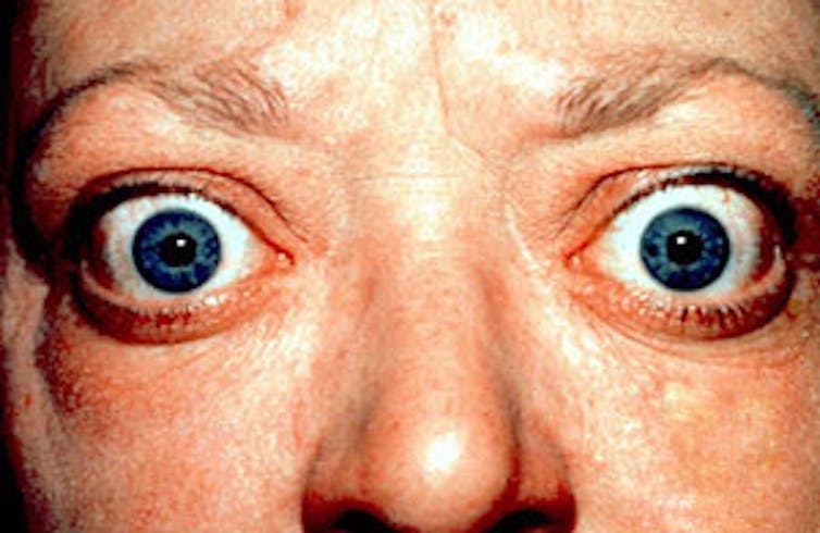 Person with bulging eyes.