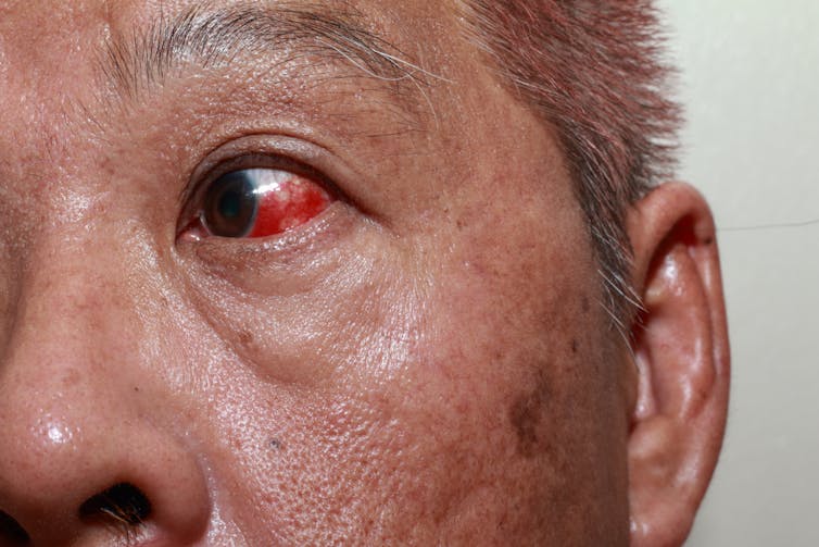 Man with a blood spot on his eye.