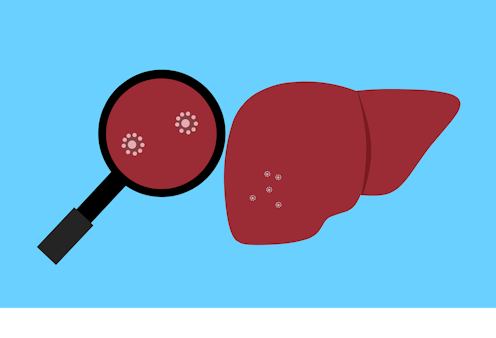 Hepatitis akut misterius mewabah: pahami gejala, siapkan langkah menghadapinya