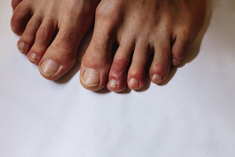 COVID Toes - How This Surprising COVID-19 Symptom Can Impact Skin